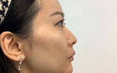 TC_04161 Refine your profile with chin filler in Streatham & Sydenham. Doctor-led hyaluronic acid contouring for balanced, natural results at our South London clinics.