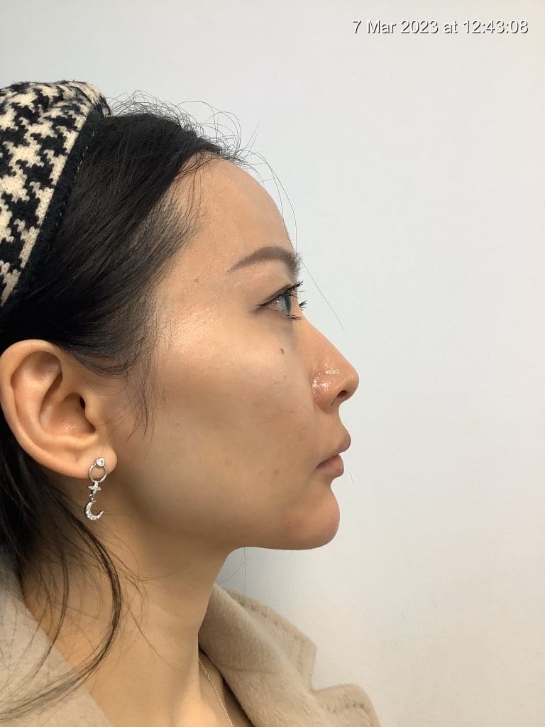 Refine your profile with chin filler in Streatham & Sydenham. Doctor-led hyaluronic acid contouring for balanced, natural results at our South London clinics.
