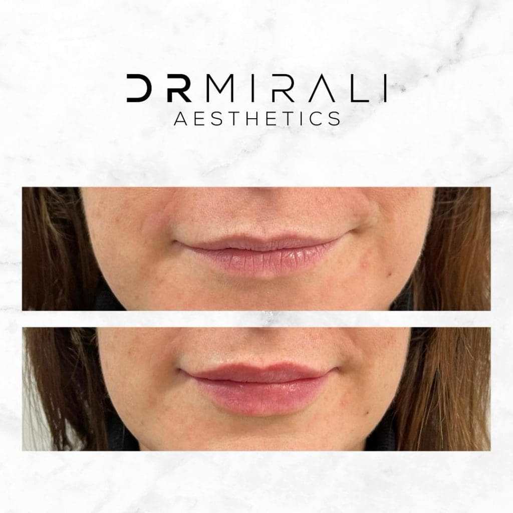 Lip Fillers in Sydenham | Doctor-Led Lip Enhancements – Dr Mirali