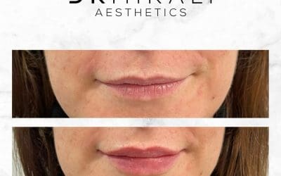 Lip Fillers in Sydenham | Doctor-Led Lip Enhancements – Dr Mirali