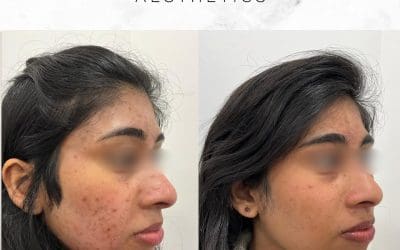 Obagi Blue Peel results at Dr Mirali Aesthetics Streatham