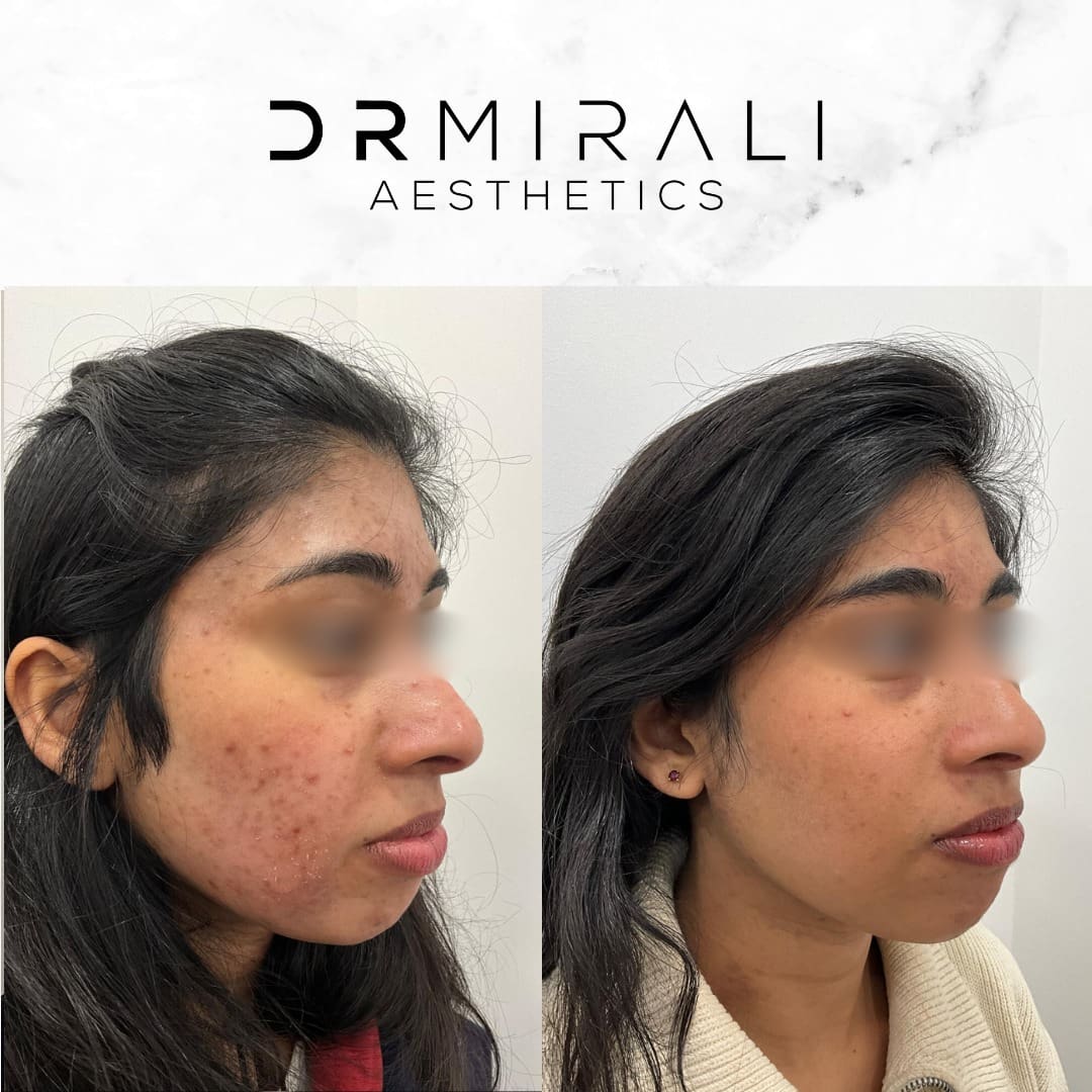 Obagi Blue Peel results at Dr Mirali Aesthetics Streatham
