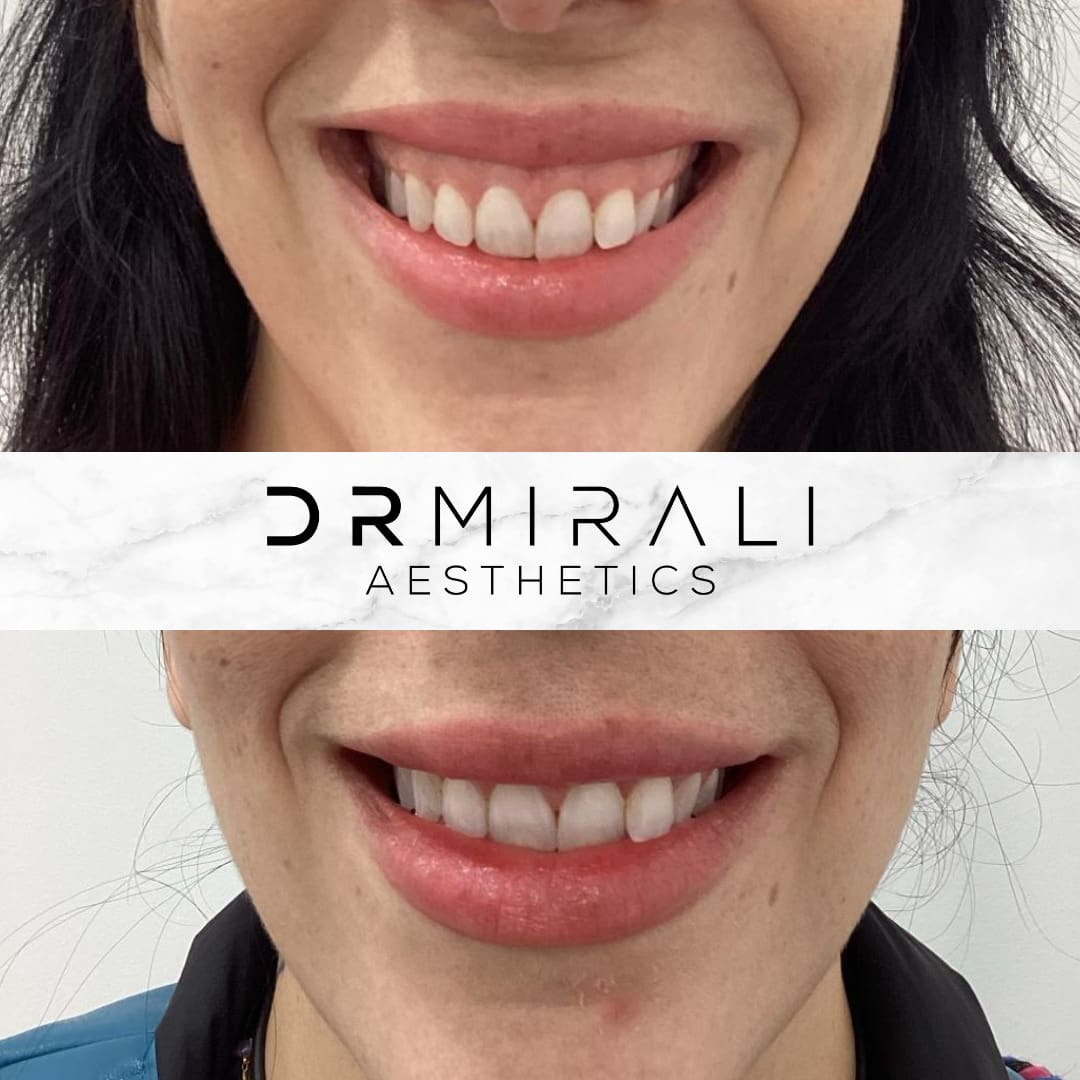 Gummy Smile Correction results at Dr Mirali Aesthetics Streatham