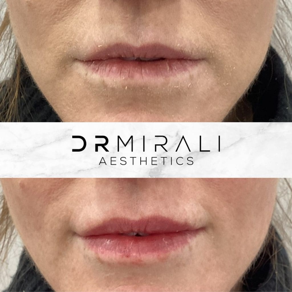 Lip filler results at Dr Mirali Aesthetics Streatham