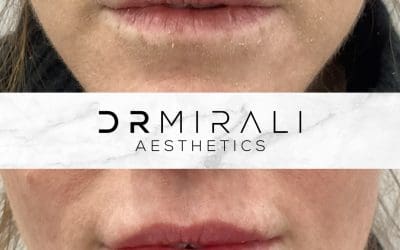 Lip filler results at Dr Mirali Aesthetics Streatham