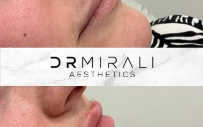 Enhance shape, symmetry and hydration with lip filler in Streatham and Sydenham. Doctor-led hyaluronic acid treatment for natural results at our South London clinics.