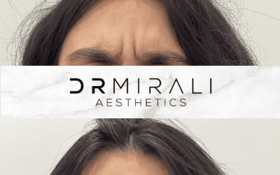 Frown Line results at Dr Mirali Aesthetics Streatham