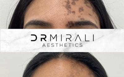 Face Mesotherapy results at Dr Mirali Aesthetics Streatham