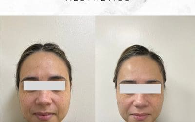 Ease clenching and refine the lower face with bruxism treatment & jawline slimming in Streatham & Sydenham. Doctor-led approach at our South London clinics.