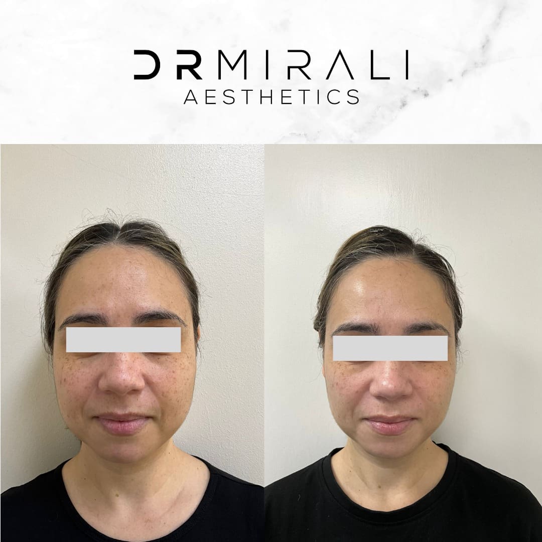Ease clenching and refine the lower face with bruxism treatment & jawline slimming in Streatham & Sydenham. Doctor-led approach at our South London clinics.