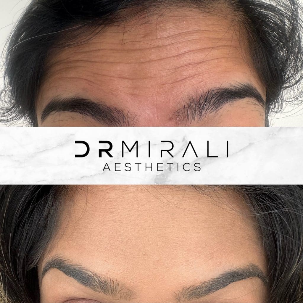 Before and after results of Botox on a patient's forehead lines