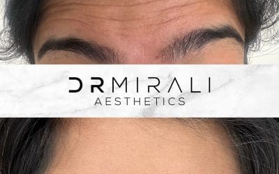 f0bb3d2d-a4fa-4849-8631-c4f8bd62ea93 Before and after results of Botox on a patient's forehead lines