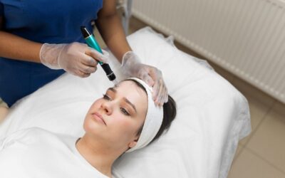 Microneedling in Sydenham Clinic Profhilo injection at Sydenham Aesthetic Clinic