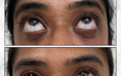 WhatsApp Image 2025-08-21 at 16.00.35_c1a5cd2c Patient receiving undereye polynucleotide injections at Dr Mirali Aesthetics South London