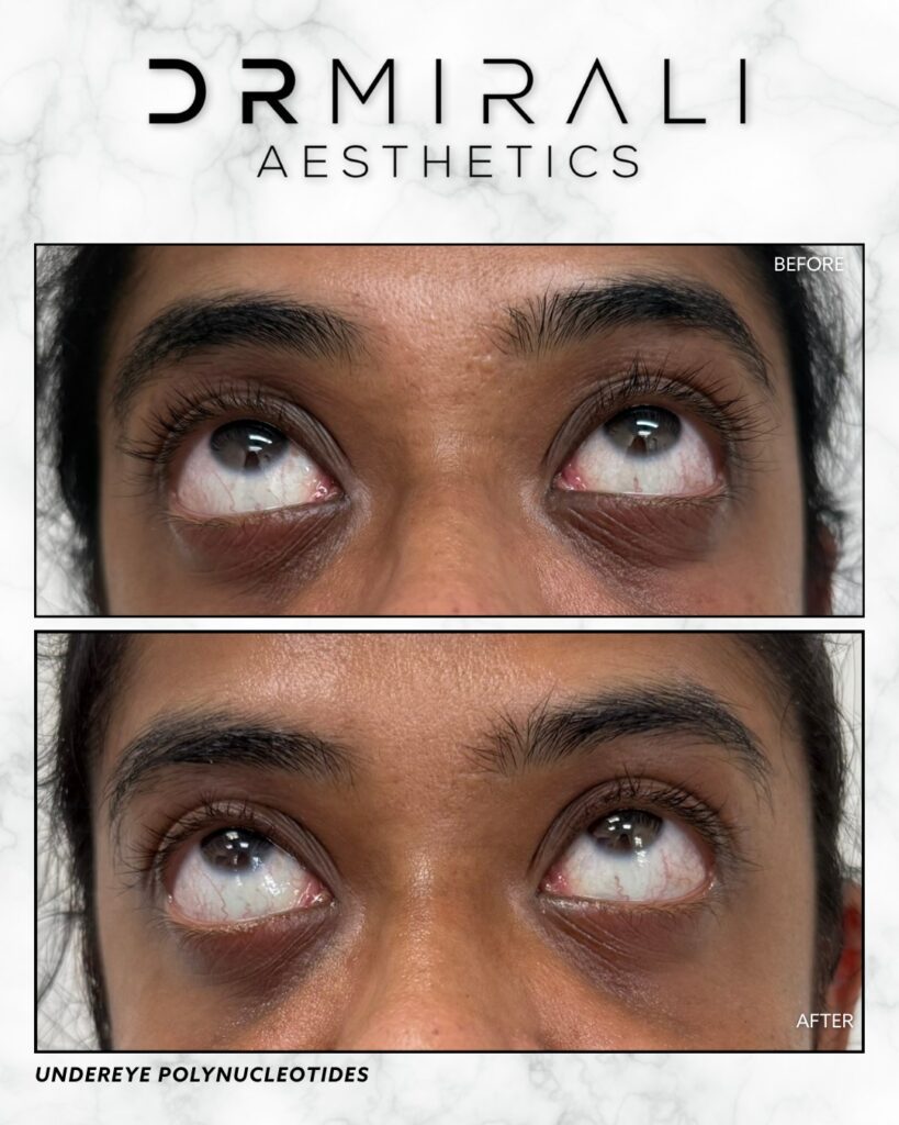Undereye Polynucleotides in Streatham & Sydenham