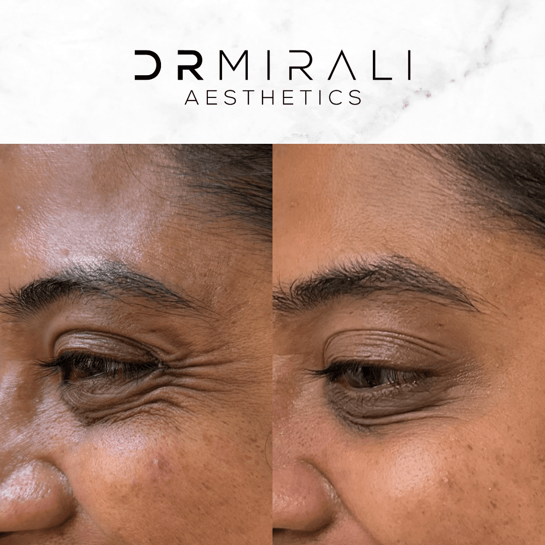Patient Love (1) Soften crow’s feet (eye smile lines) with a personalised plan at Dr Mirali Aesthetics. Crow’s feet treatment in Streatham and Sydenham for natural, doctor-led results at our South London clinics.