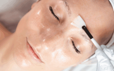 Perfect-Peel-Treatment-DrMiraliAesthetics Obagi chemical peel being applied in Sydenham clinic