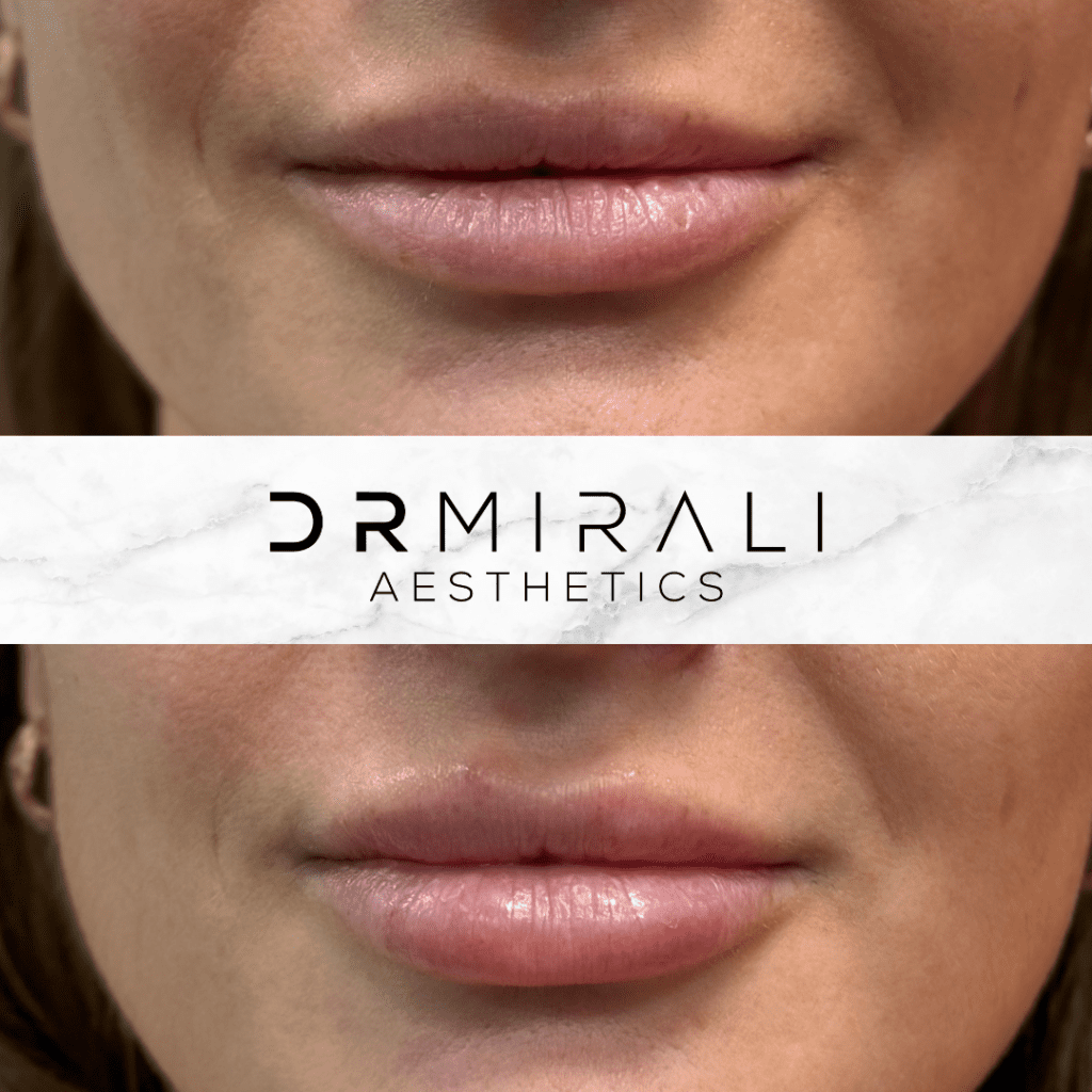 Doctor performing natural lip filler treatment at South London clinic