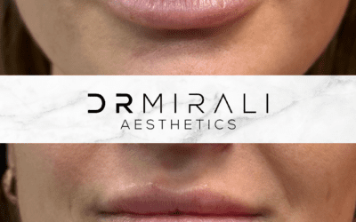Lip Fillers in South London Doctor performing natural lip filler treatment at South London clinic