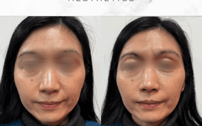 Patient Love (1) Doctor treating peri-oral lines at South London aesthetic clinic