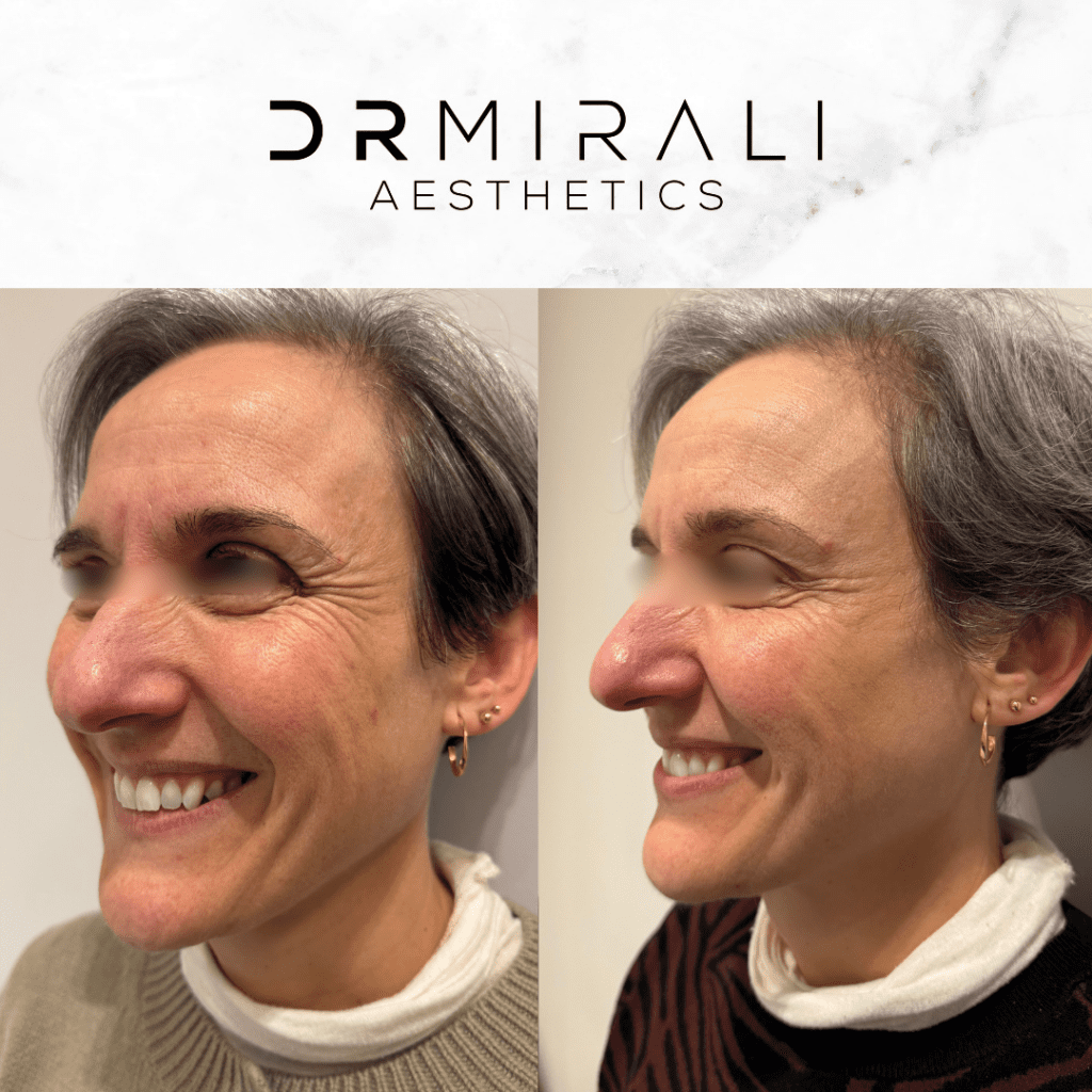 Doctor treating crow’s feet lines at South London aesthetic clinic