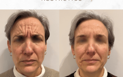 Forehead Line Treatment